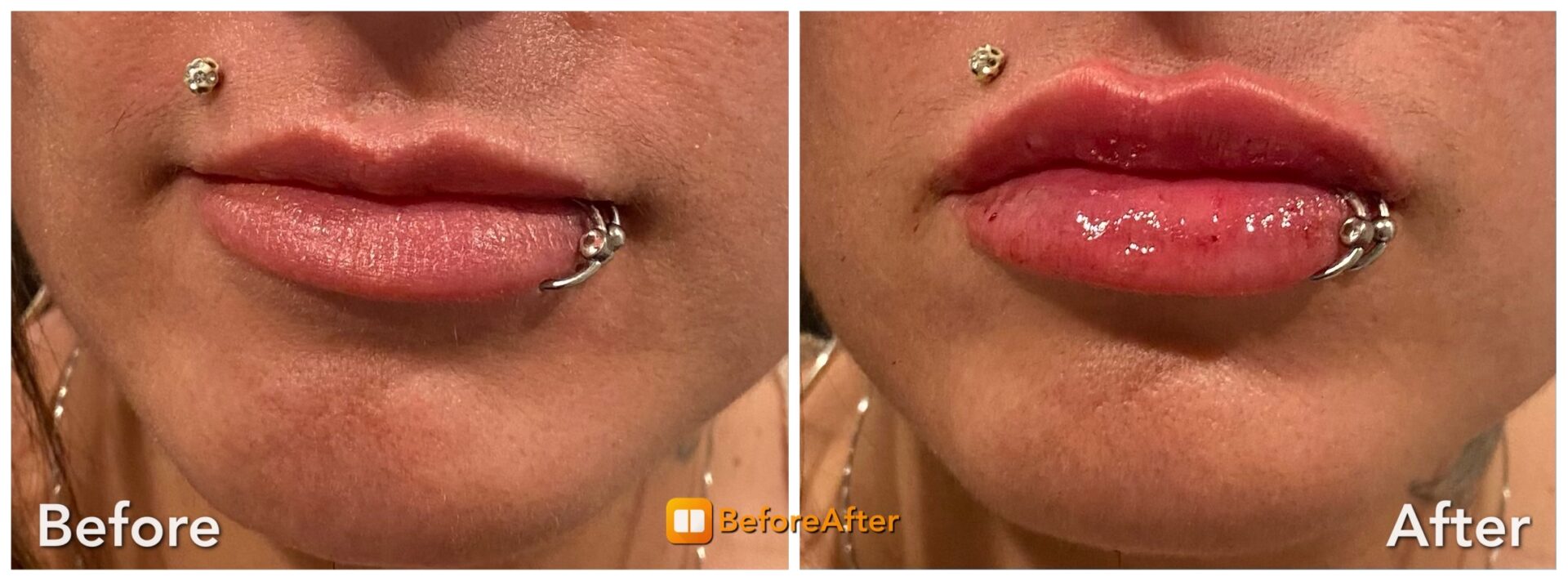 2 syringes of Juvederm over the course of 4 months. Photo is before and immediately after 2nd Syringe