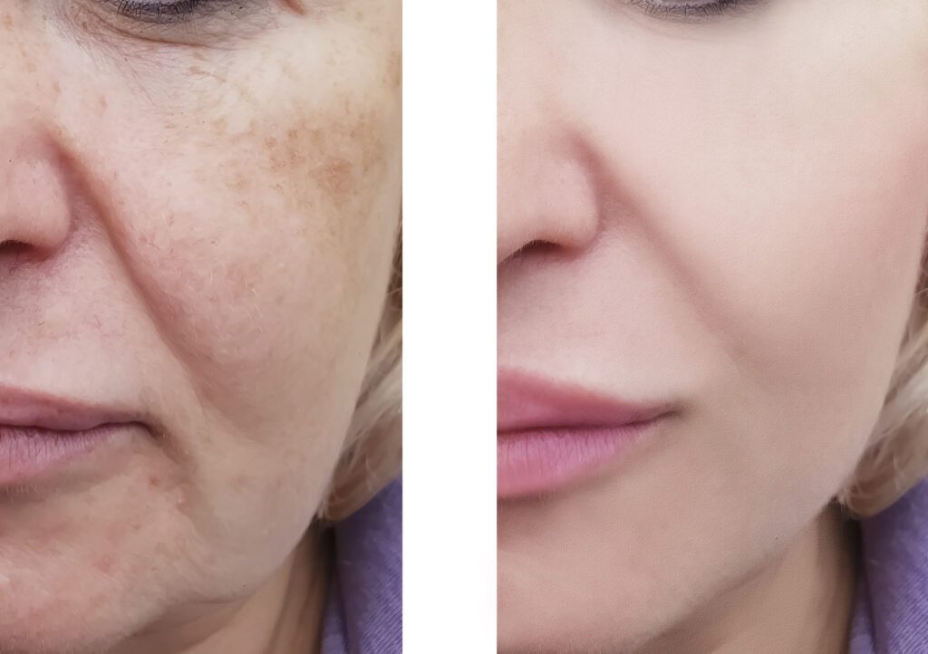 woman facial wrinkles before and after correction procedures