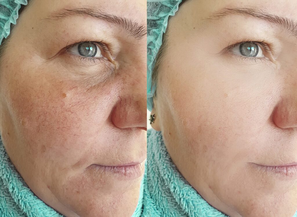 woman face wrinkles before and after treatment