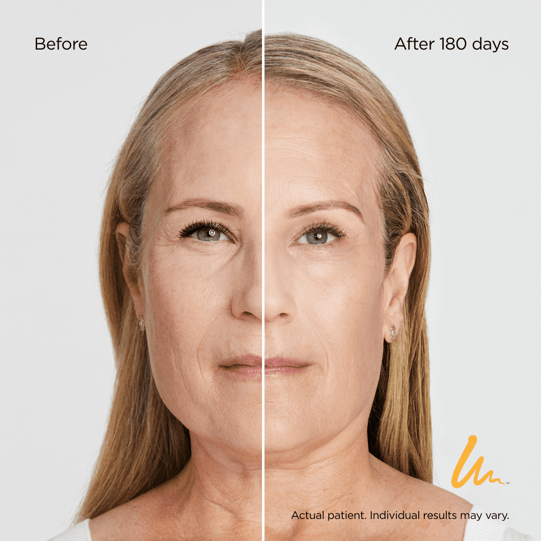 before after of Ultherapy