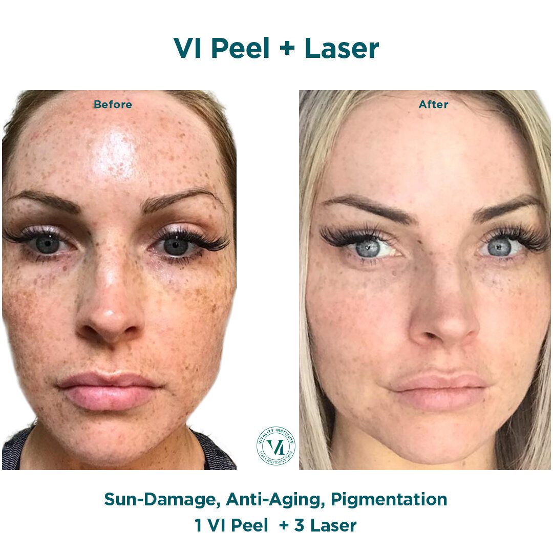 VI Peel and Laser Treatment before and after