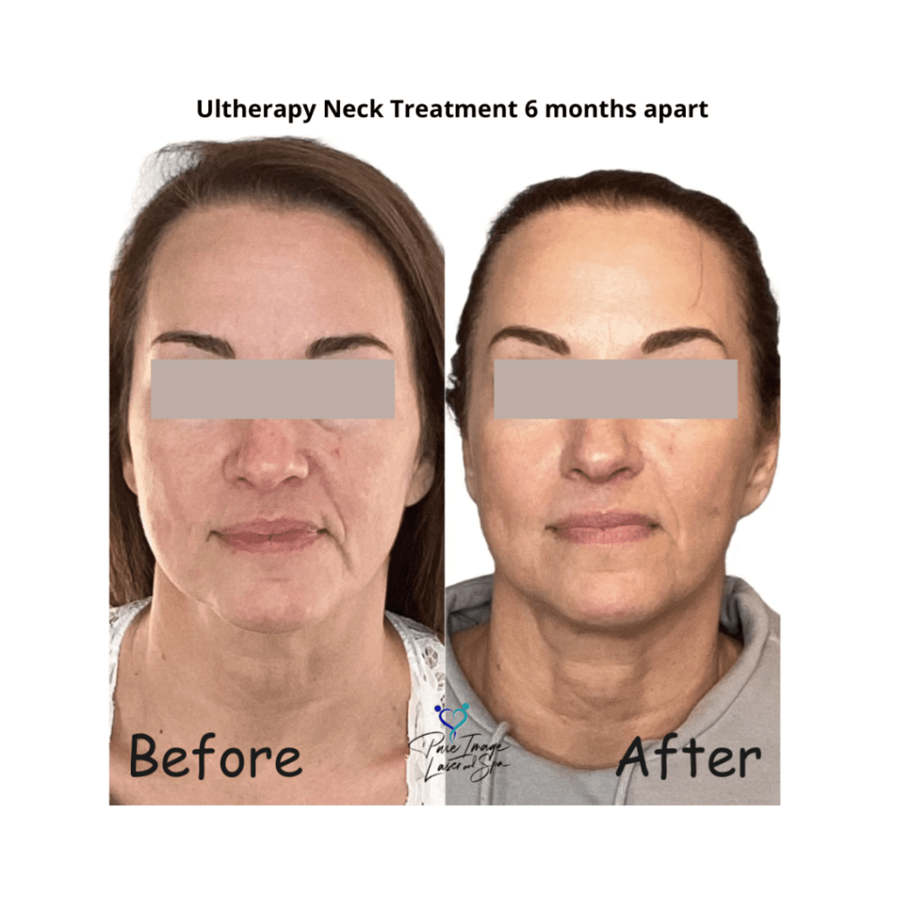 Ultherapy Neck Treatment