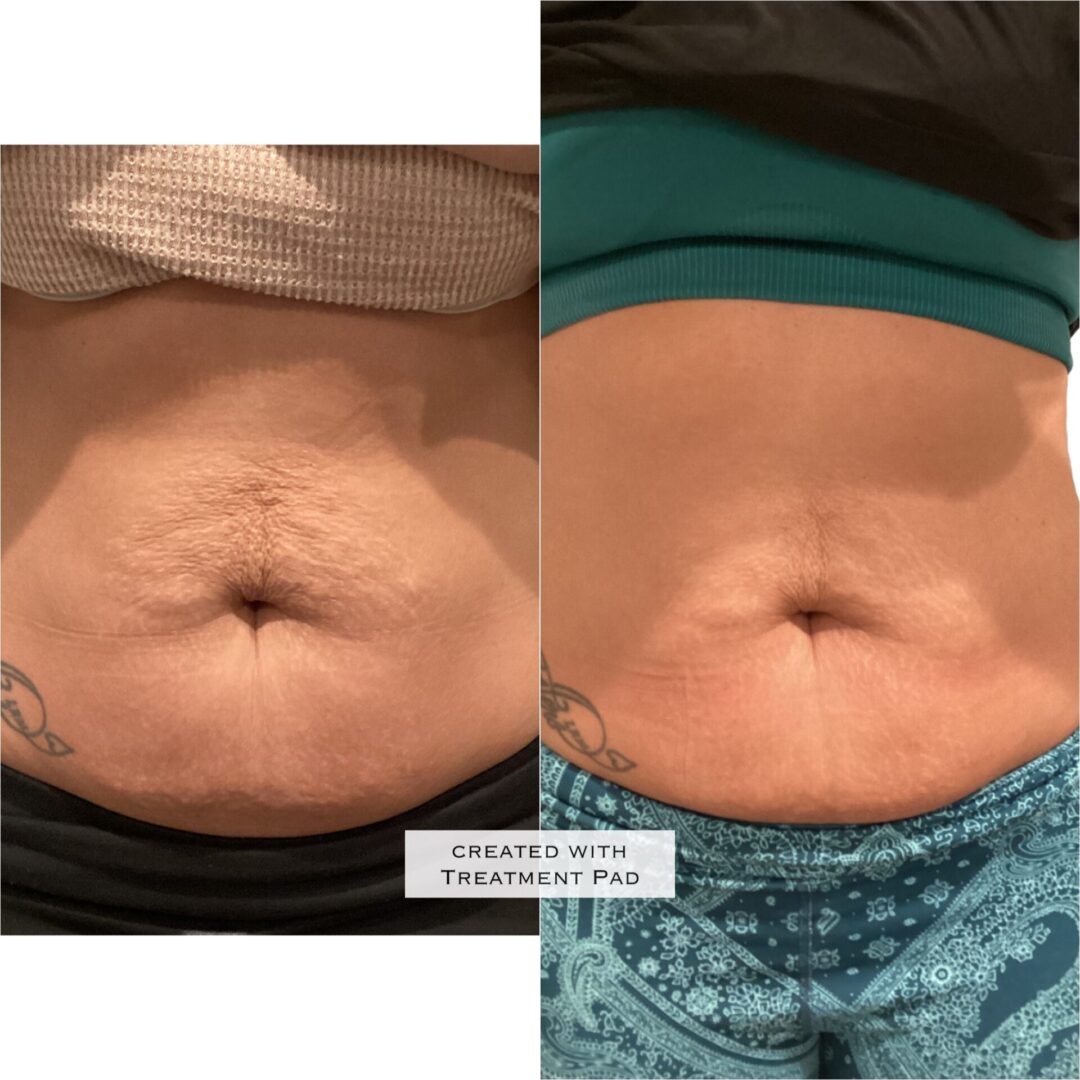 Ultherapy stomach results