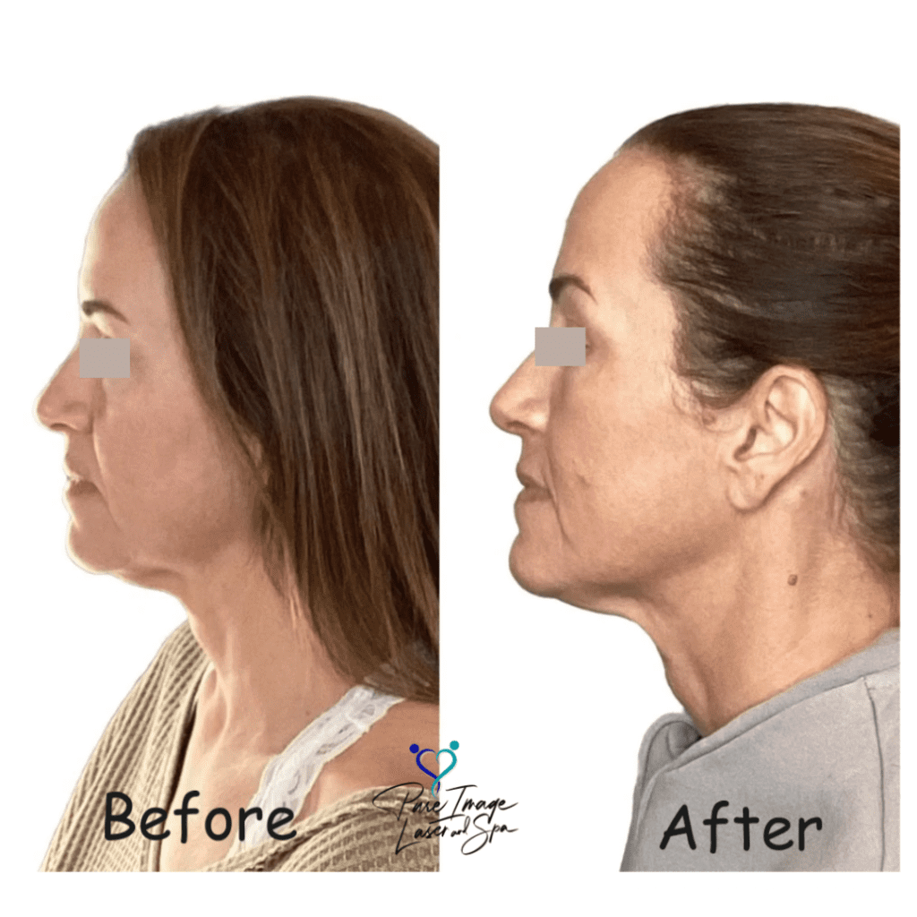 Ultherapy Before and After