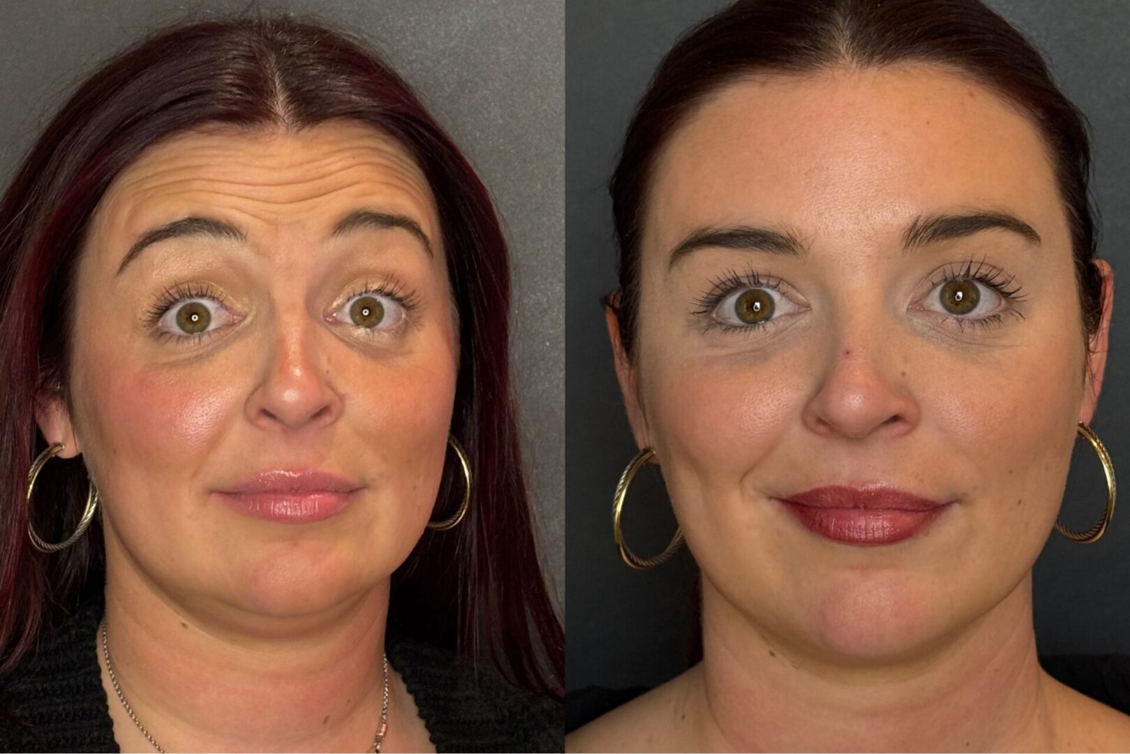 Dysport before and after surprised indianapolis