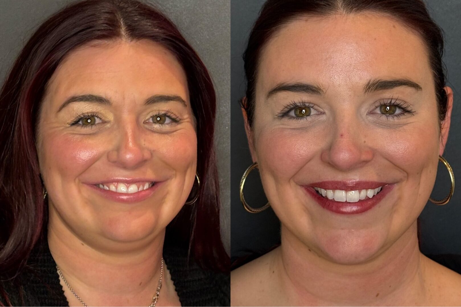 Dysport Lip Flip before and after indianapolis