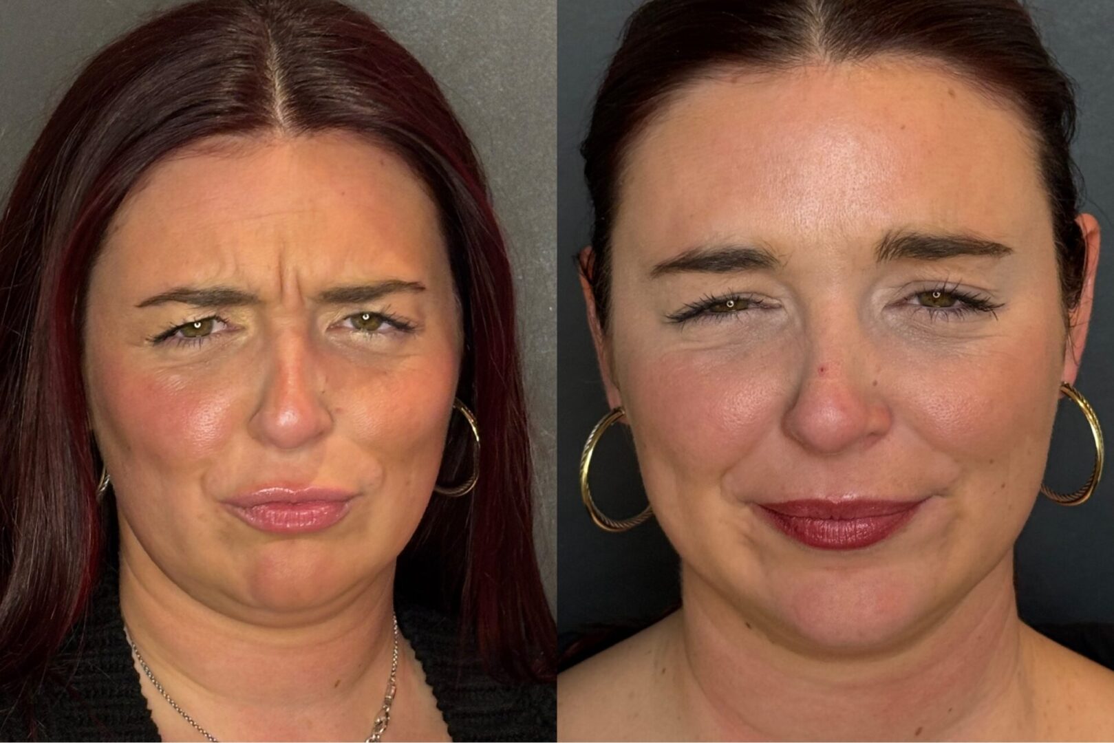 Dysport Scowling Indianapolis Before and After