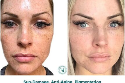 What Is a Chemical Peel and How Does It Transform Skin?